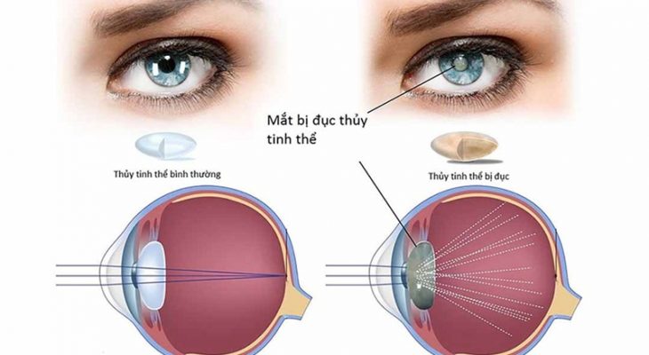 Đục thủy tinh thể dẫn tới mù lòa