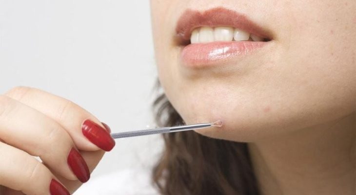 trị mụn bằng thuốc nhỏ mắt